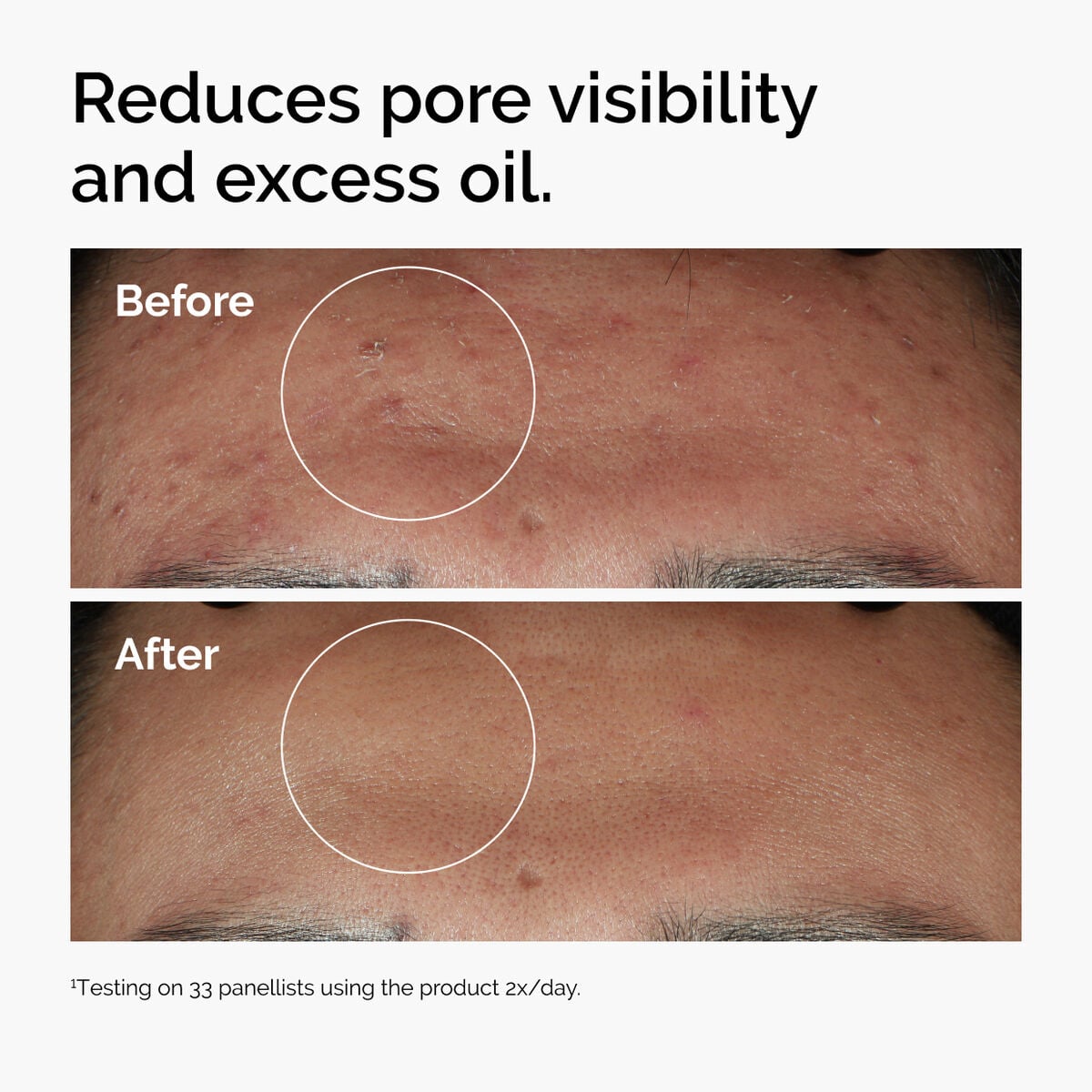 niacinamide-10-zinc-1-y2 ord-niacinamide-zinc-blemish-serum-before-after-pores.jpg