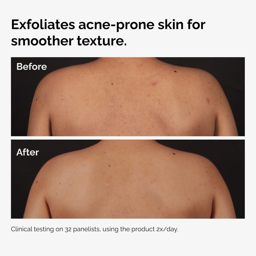 the-body-care-collection-w3 ord-salicylic-acid-body-serum-before-after-graphic-NA.jpg