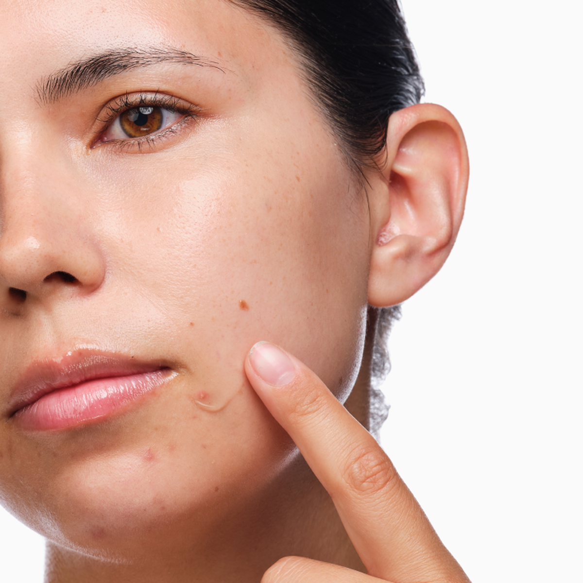 the-acne-set-p8 rdn-the-acne-set-application.png